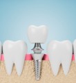Représentation d'un implant au cabinet dentaire Implantocean