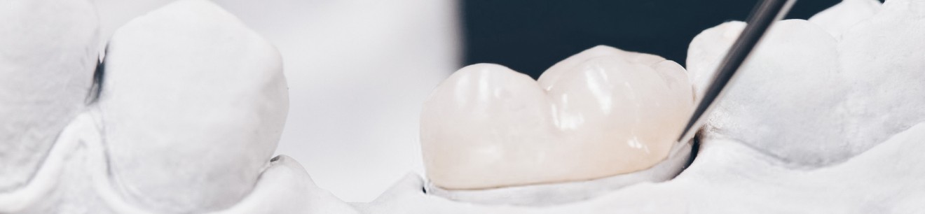 Le composite stratifié au cabinet dentaire Implantocean à La Baule