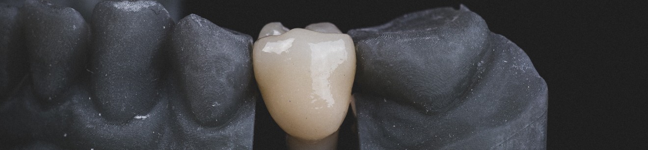 Une couronne dentaire au cabinet Implantocean à La Baule