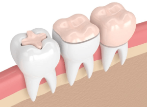 Onlays proposés au cabinet Implantocean à La Baule